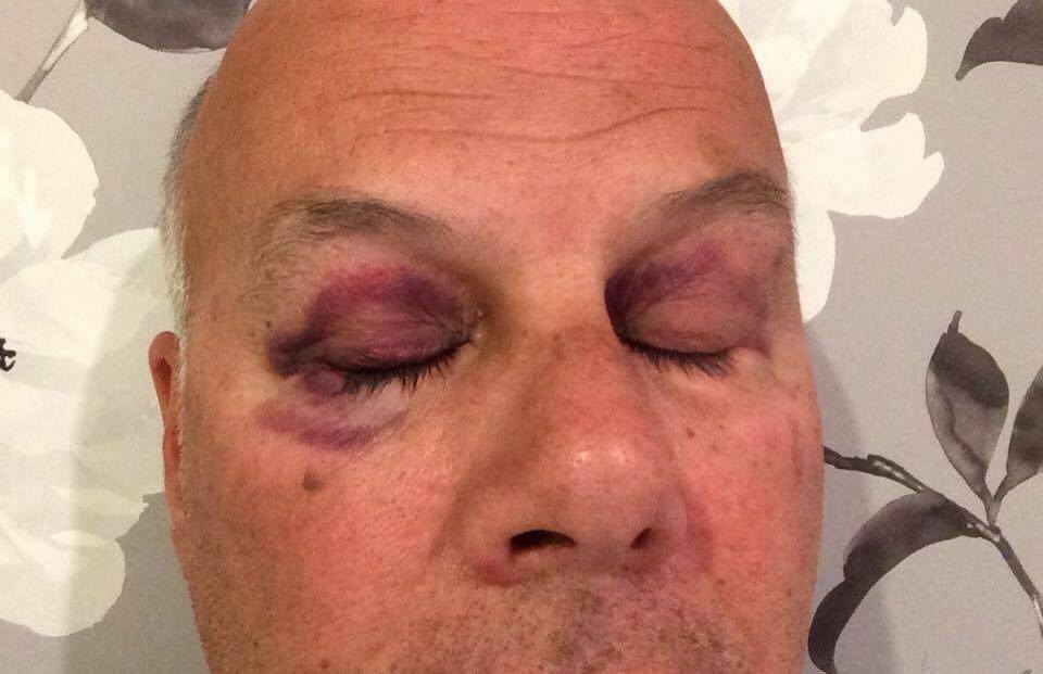 black eyes from wakeboard crash