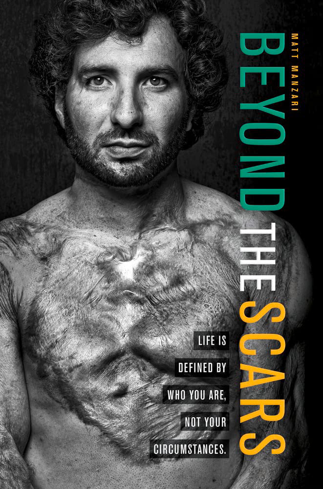 Matt Manzari Beyond the Scars: Life is Defined by Who You Are, Not Your Circumstances